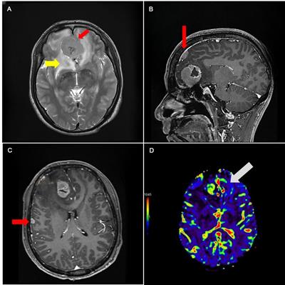 Case report and literature review: Treatment of multiple meningiomas combined with multiple unruptured aneurysms in a single operation